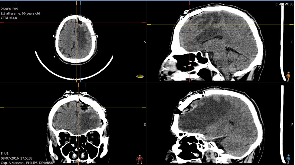 Meningioma SSS - TC encefalo postop