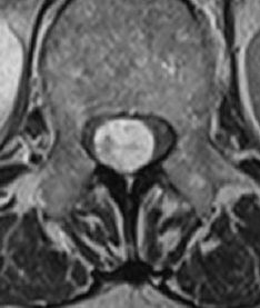 RMN T2 assiale preop mdc - E' evidente che la lesione iperintensa occupa la quasi totalità del canale vertebrale.