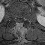 RMN T1 mdc postop - rimozione completa della neoplasia con decompressione delle strutture nervose