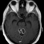 Nocardia - RMN encefalo T1 mdc preop