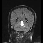 Nocardia - RMN encefalo T2 postop
